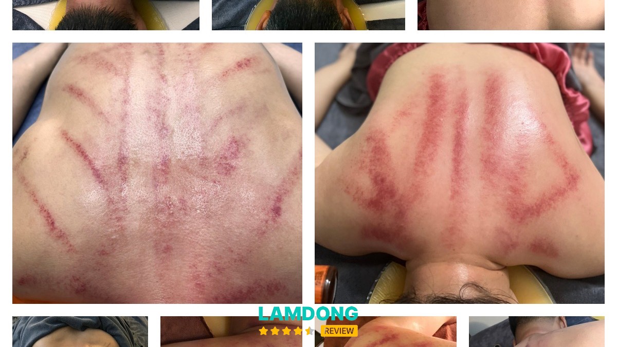 Massage Châm Cứu Bấm Huyệt Trị Liệu Hoa Đông y – trị liệu đông y